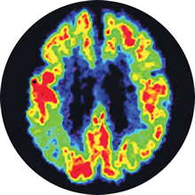 PET scan of Alzheimer's affected brain for comparison to the healthy patient