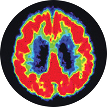 PET scan of healthy brain for comparison to the Alzheimer's patient