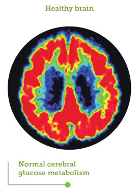 Area of cerebral glucose metabolism in Alzheimer's disease, comparison 