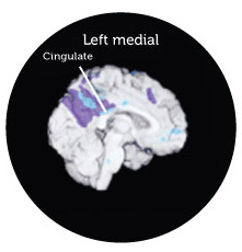 Pattern of DCGM in young men, E4 carriers and patients with probable Alzheimer's disease