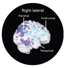 Pattern of DCGM in young men, E4 carriers and patients with probable Alzheimer's disease